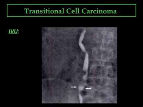 Transitional cell carcinoma