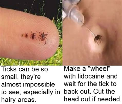 New Tricks for Removing Ticks | Tick removal, Ticks, Tick bite