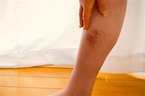 Cellulitis: Do you know the signs? | Healthing.ca