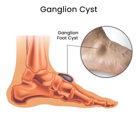 What Causes A Ganglion Cyst On Your Foot And Ankle Pr - vrogue.co