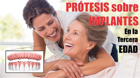 PROTESIS DENTALES COMPLETAS sobre IMPLANTES 🦷 dentadura postiza fija 🦷 ...