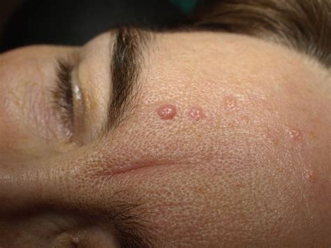 Seborrheic Keratosis Face