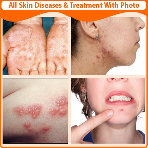 Skin Diseases and Treatment | androidrank.org