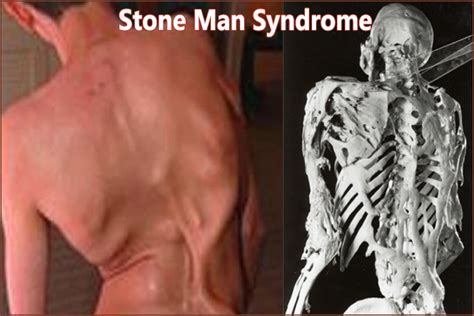 Stone Man Syndrome