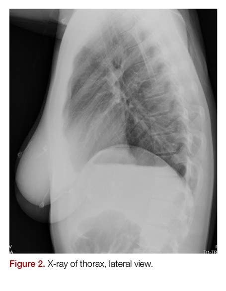 A Ticking Noise From the Chest: Recognition of the Hamman Sign | MDedge Emergency Medicine