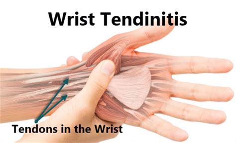 Wrist Tendonitis