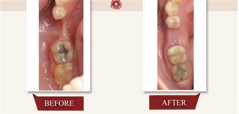 Bone Grafting For Dental Implant - French Dental Services - Dubai - Dr.Miski