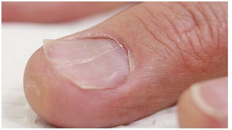 Top 139+ anemia nails vs normal nails latest - cic32.com.vn