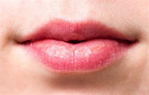 Angular Cheilitis Causes And Treatments, 54% OFF