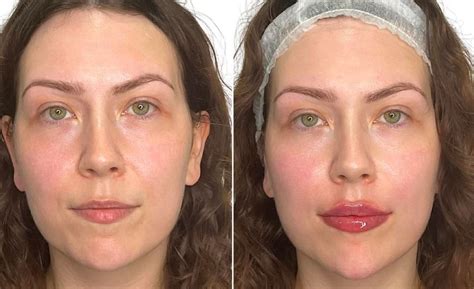 lip filler recovery  aftercare dos donts dr hass clinic