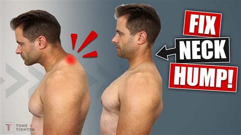 Neck Hump is Not Always Caused By Pillows ! Doctors Reveals Daytime
