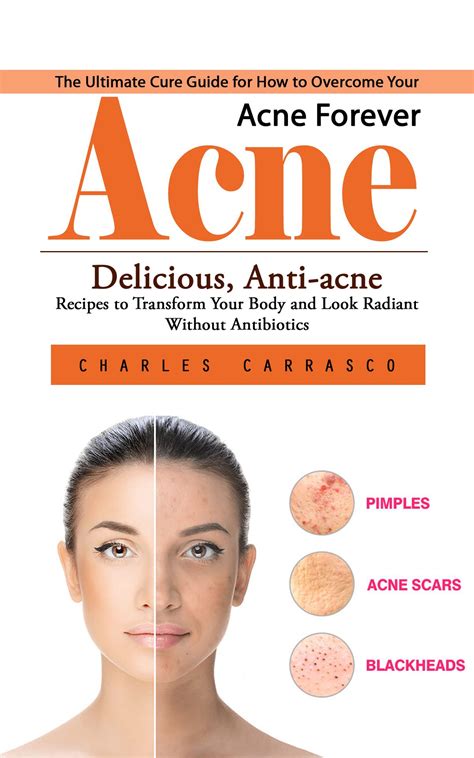 Acne: The Ultimate Cure Guide for How to Overcome Your Acne Forever ...