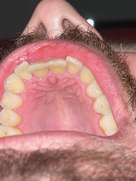 Is there something wrong with the roof of my mouth, I'm worried it