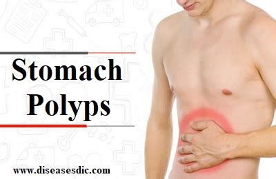 Stomach Polyps or Gastric Polyp- Definition,Types and Treatment