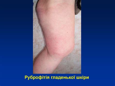 Мікози. Класифікація мікозів - online presentation