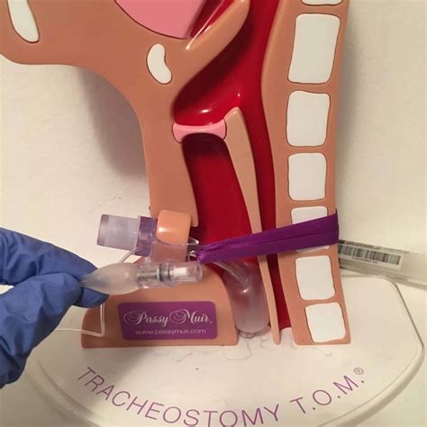 Tracheostomy Management At Home at Robert Scalia blog