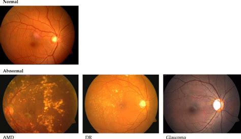 typical fundus images  normal top  abnormal bottom classes