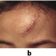 The facial wound before and after stitching and the scar at 5 weeks and ...