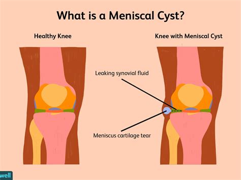 Benign Cyst On Knee