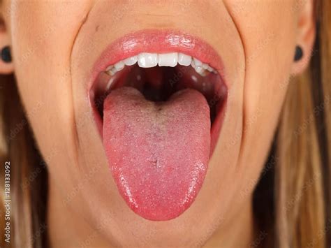 stress bumps  tongue