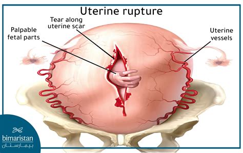 Uterine Rupture: Causes & Treatment in Turkey - Bimaristan