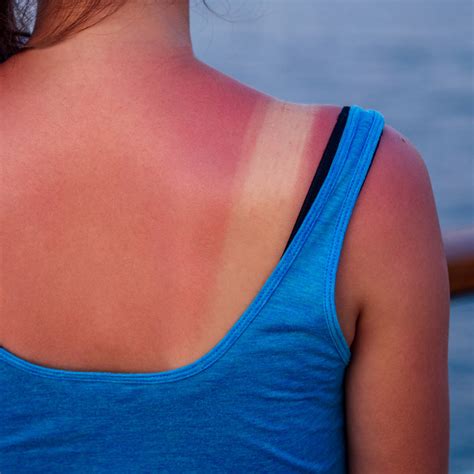 photosensitivity    symptoms rash