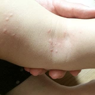 子供によくみられる接触皮膚炎｜女医の巣鴨千石皮ふ科