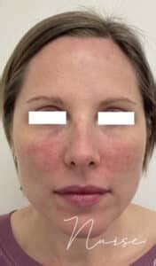 BBL Rosacea Case #3198 - Distinct Medical Aesthetics