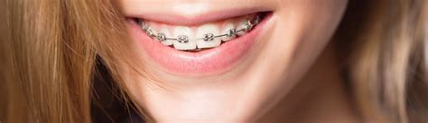 braces johnson orthodontics des moines ia