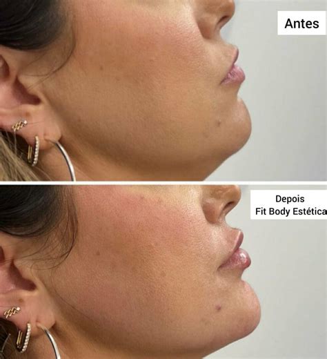 Contorno Mandibular Antes E Depois - Exercicios De Mandibula Antes E Depois