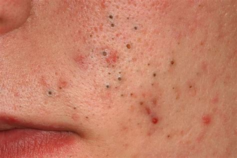 comedones  comedonal acne