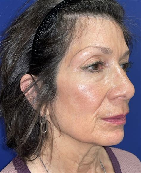 Patient 36405 Mini Facelift Results Before & After Photos