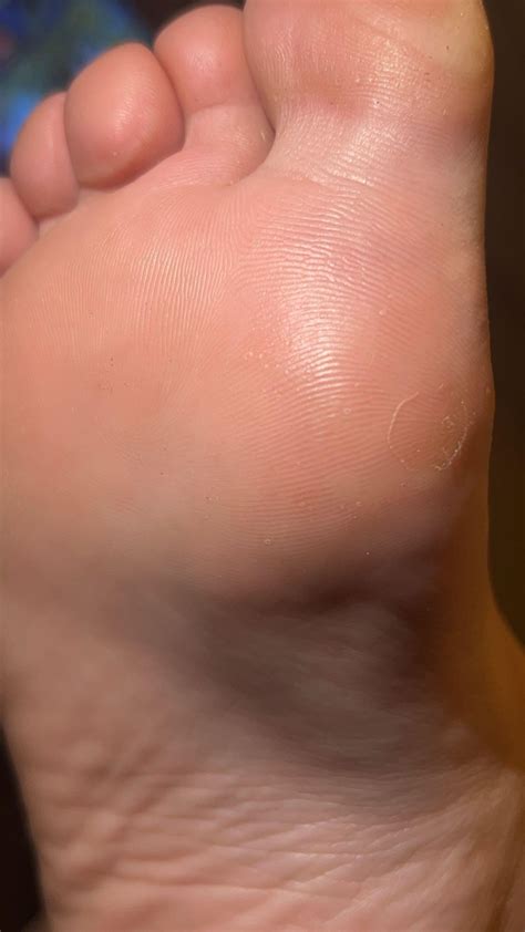 Tiny bumps on bottoms of feet : r/DermatologyQuestions