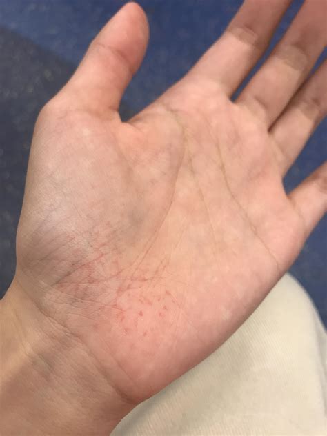 I just learned that I wasn’t supposed to use my palm to break my fall