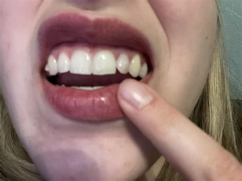 Tooth is suddenly turning gray... is it dead/dying? : r/Invisalign