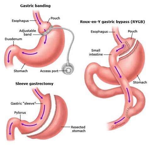 Weight loss surgery, types, costs, indications, side effects & benefits