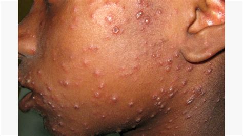 rash  skin  feels hot   touch