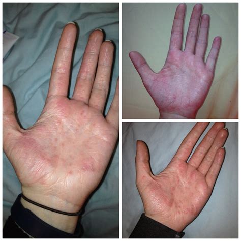 Contact Dermatitis Palms