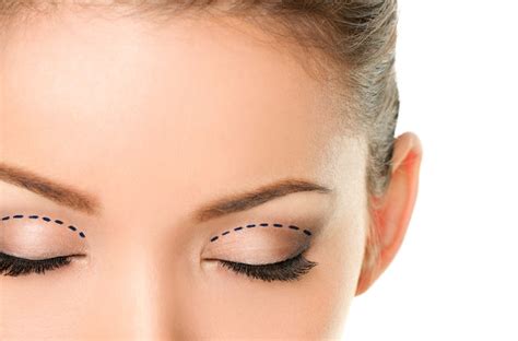 Cosmetic Eyelid Surgery | Clearview Eye Centre | Calgary