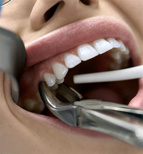 teeth extractions seawall dental