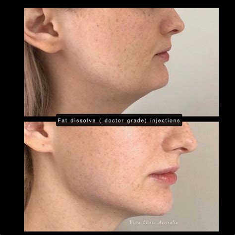Fat dissolving injections Melbourne- Vista Clinic