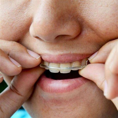 how to know if your retainer doesn't fit