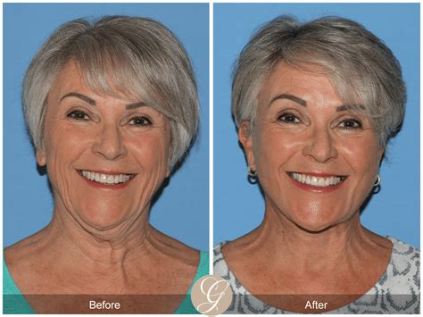 Deep Plane Facelift and Deep Plane NeckLift Case 1 Before After Photos ...