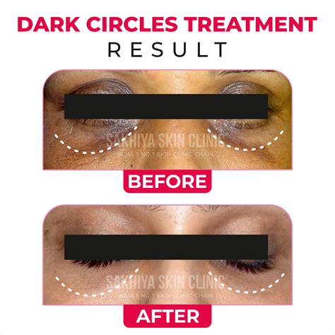 Dark Circles - Sakhiya Skin Clinic