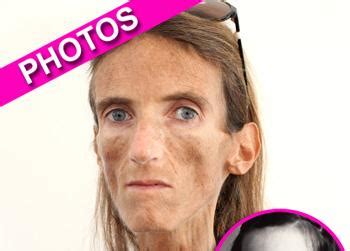 heartbreaking tale  worlds thinnest woman campaigning