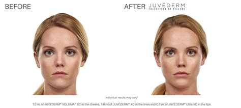 juvederm    real patient results
