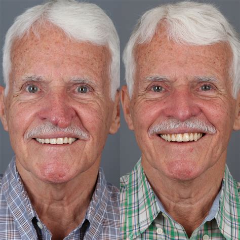 Patient 123046239 | Rhinophyma Gallery | Vila Facial Plastic Surgery