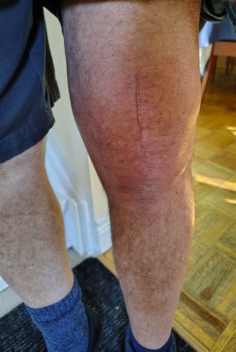 Knee Replacement Recovery, 21 – Scripturient