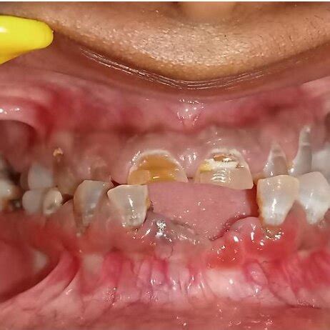 clinical photograph showing multiple attrited opalescent teeth