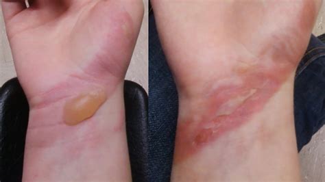 Queimadura De 2 Grau Antes E Depois - Queimadura Segundo Grau Cid - RETOEDU